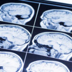 BrainInj3 BrainInj3